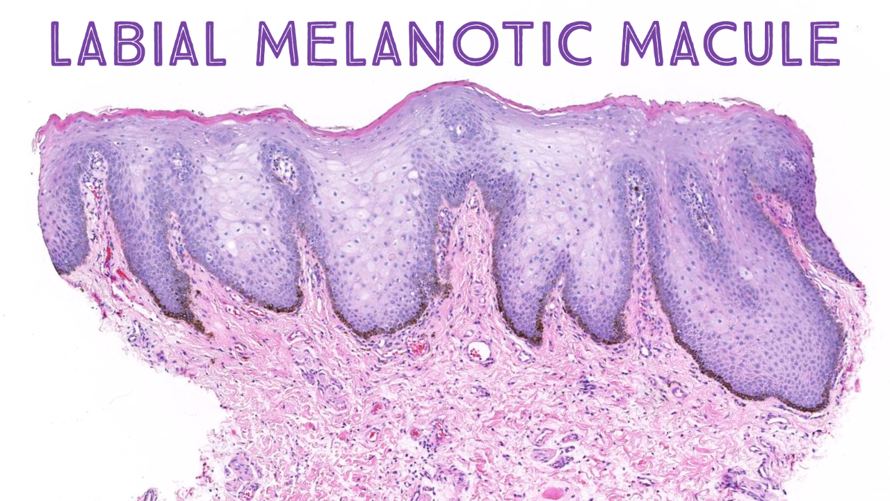Labial Melanotic Macule brown Spot On Lip Stony Brook Case 1 Video Labial Melanotic Macule brown Spot On Lip Stony Brook Case 1 Video